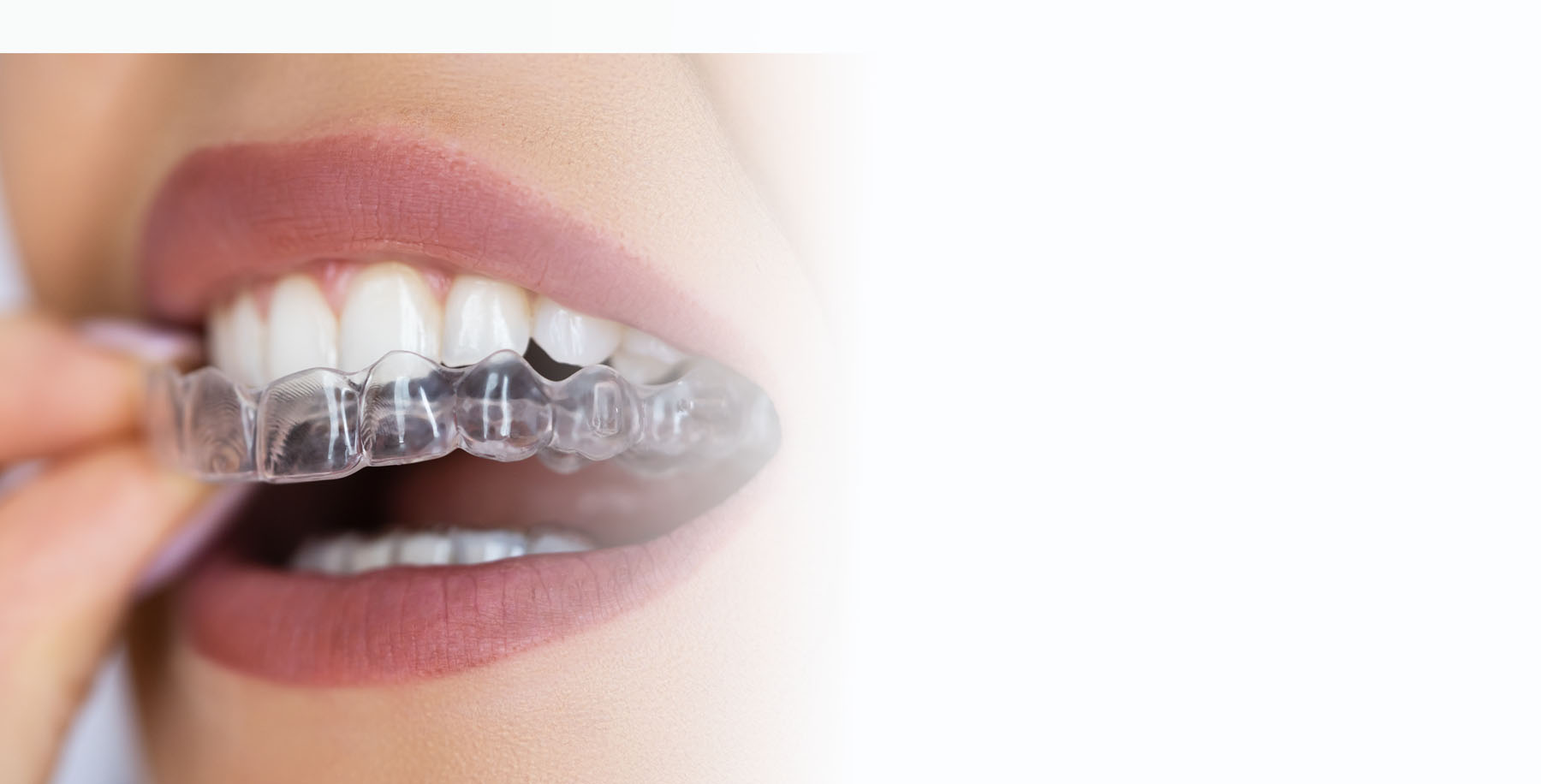 Biggest Savings Ever – $2,500 Off Clear Aligners
