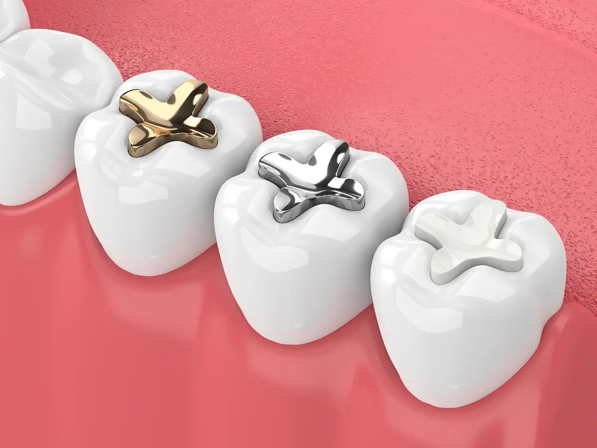 Tooth Fillings & Sealants